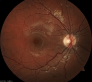 Retina-Fabsi